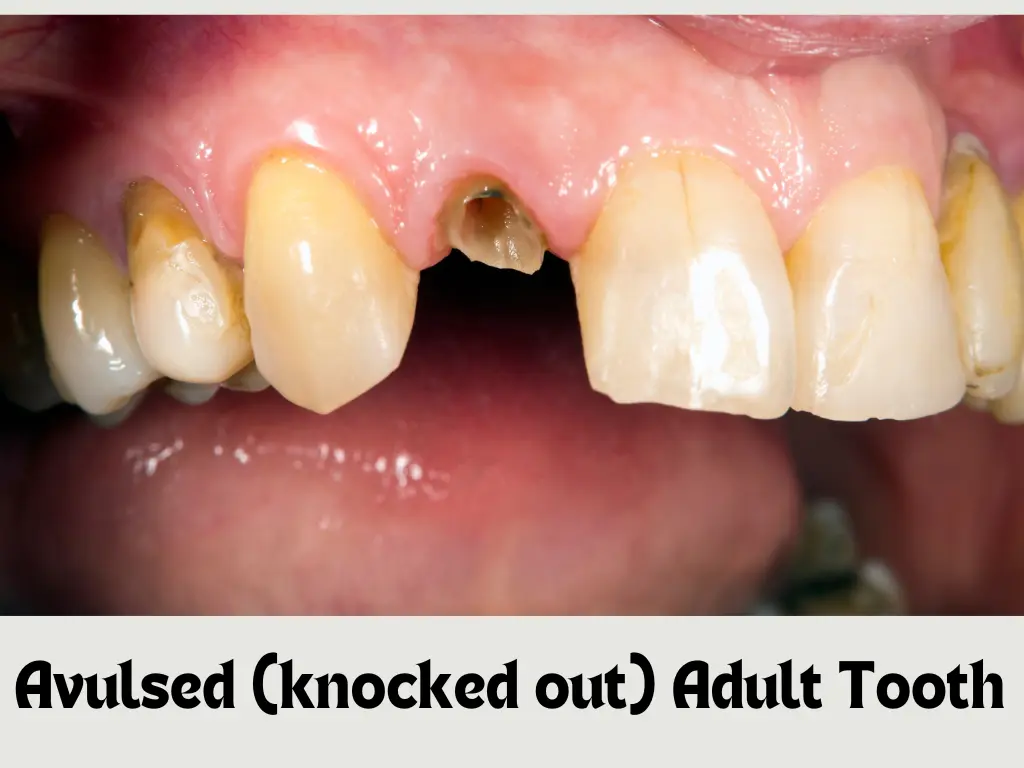 Emergency dental treatment for a child with a knocked-out tooth
