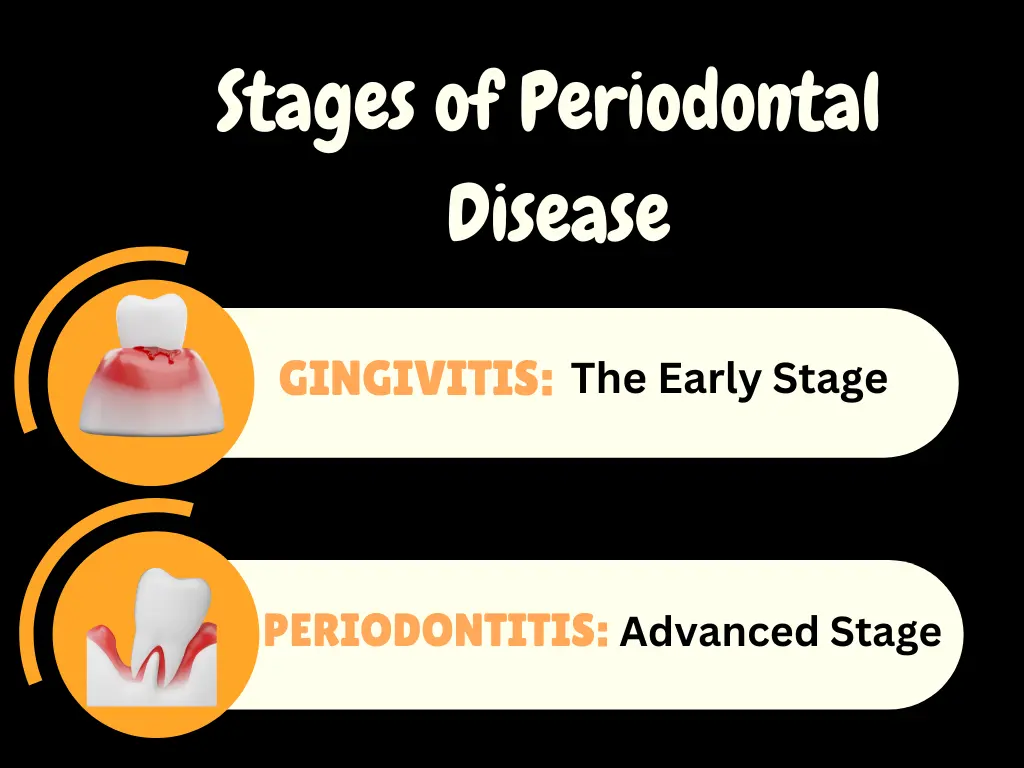 Diagram showing the stages of periodontal disease
