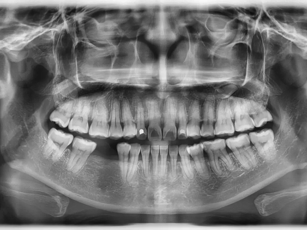 X-ray showing bone loss from periodontitis
