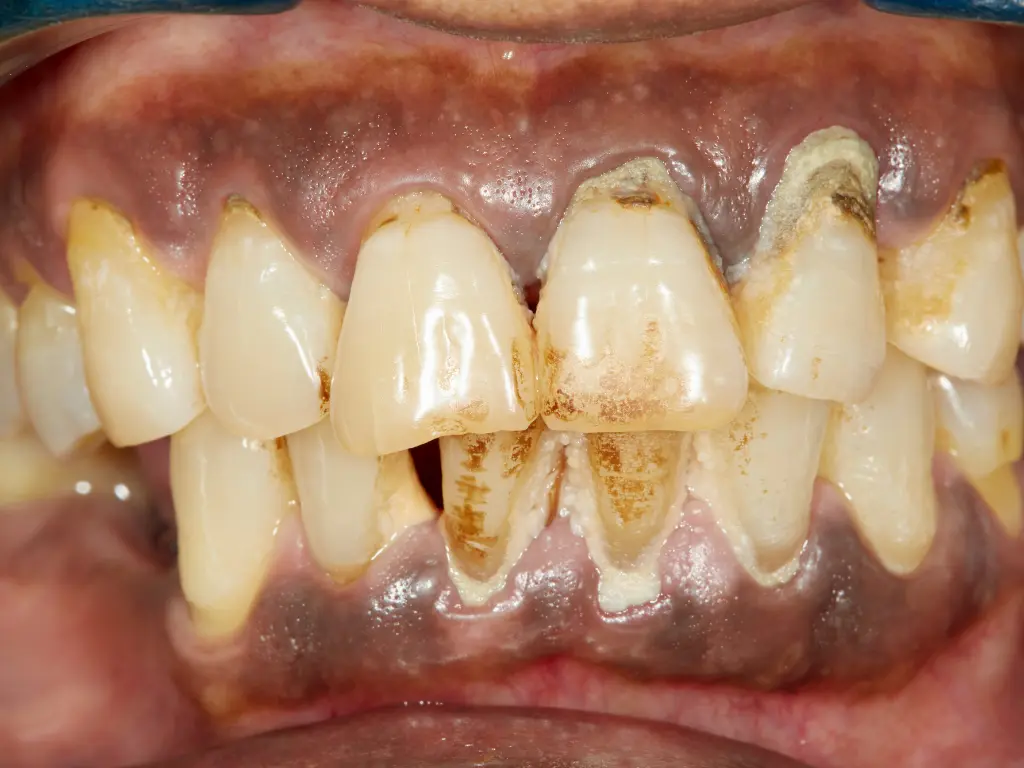 A diagram showing teeth and gums affected by periodontitis due to excessive calculus deposits
