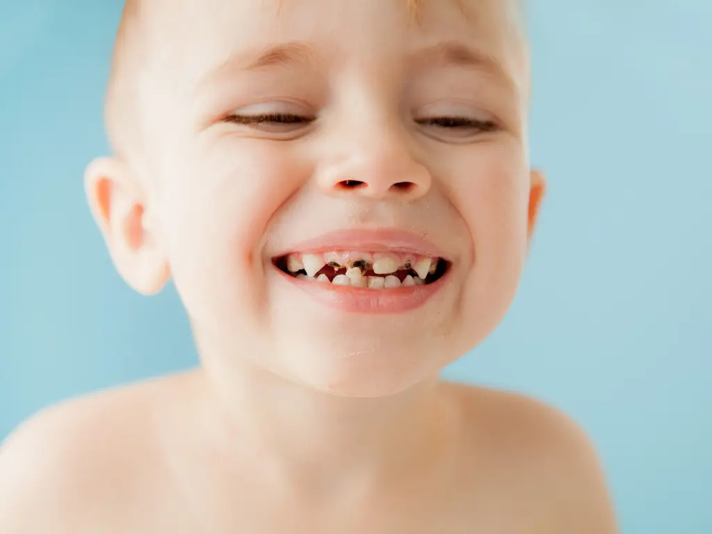 Understanding early childhood caries and the importance of dental home for its treatment