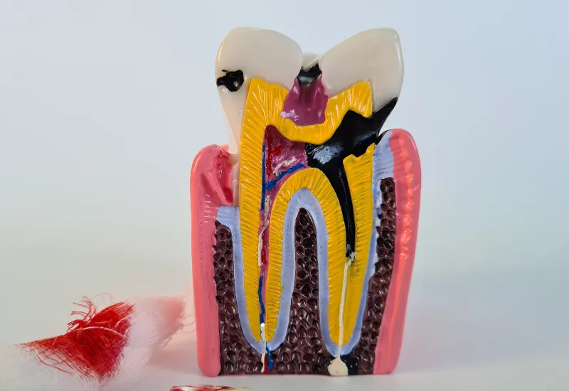 Cavity Treatment for Kids In Houston, TX