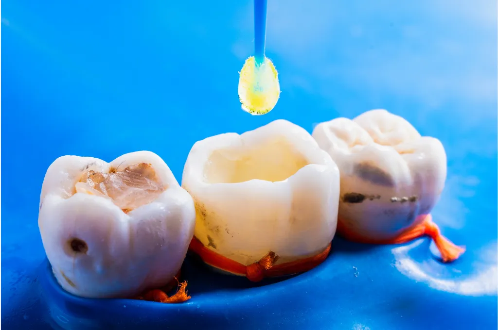 Dental Fillings in Houston