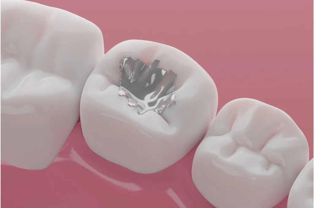 What Are Dental Fillings?