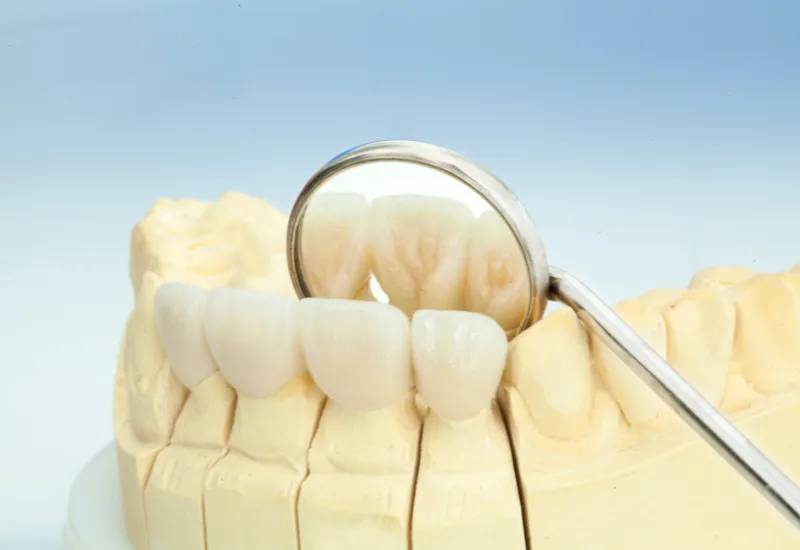 What Are Dental Sealants