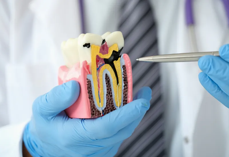 What is Cavity Treatment