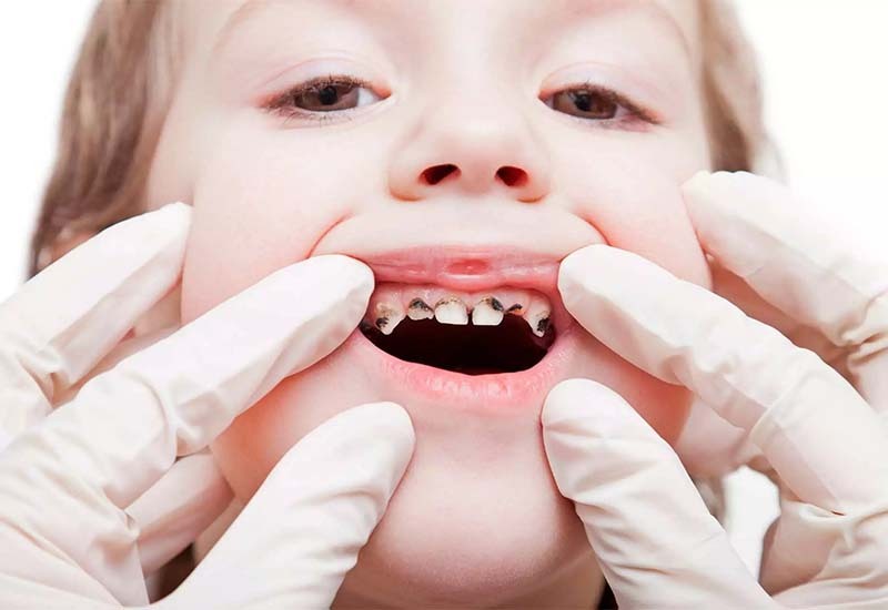 Pediatric dental team experienced in children’s cavity care